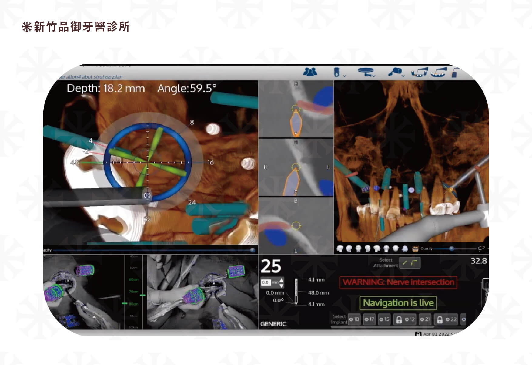 品御牙醫使用X-Guide 藍光導航，植牙非常精準是傳統徒手植牙的十倍以上