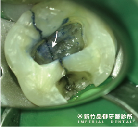 大顆的裂齒俯視照