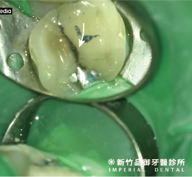 小顆的裂齒俯視照