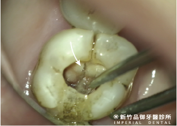 看起來很痛的劈裂臼齒