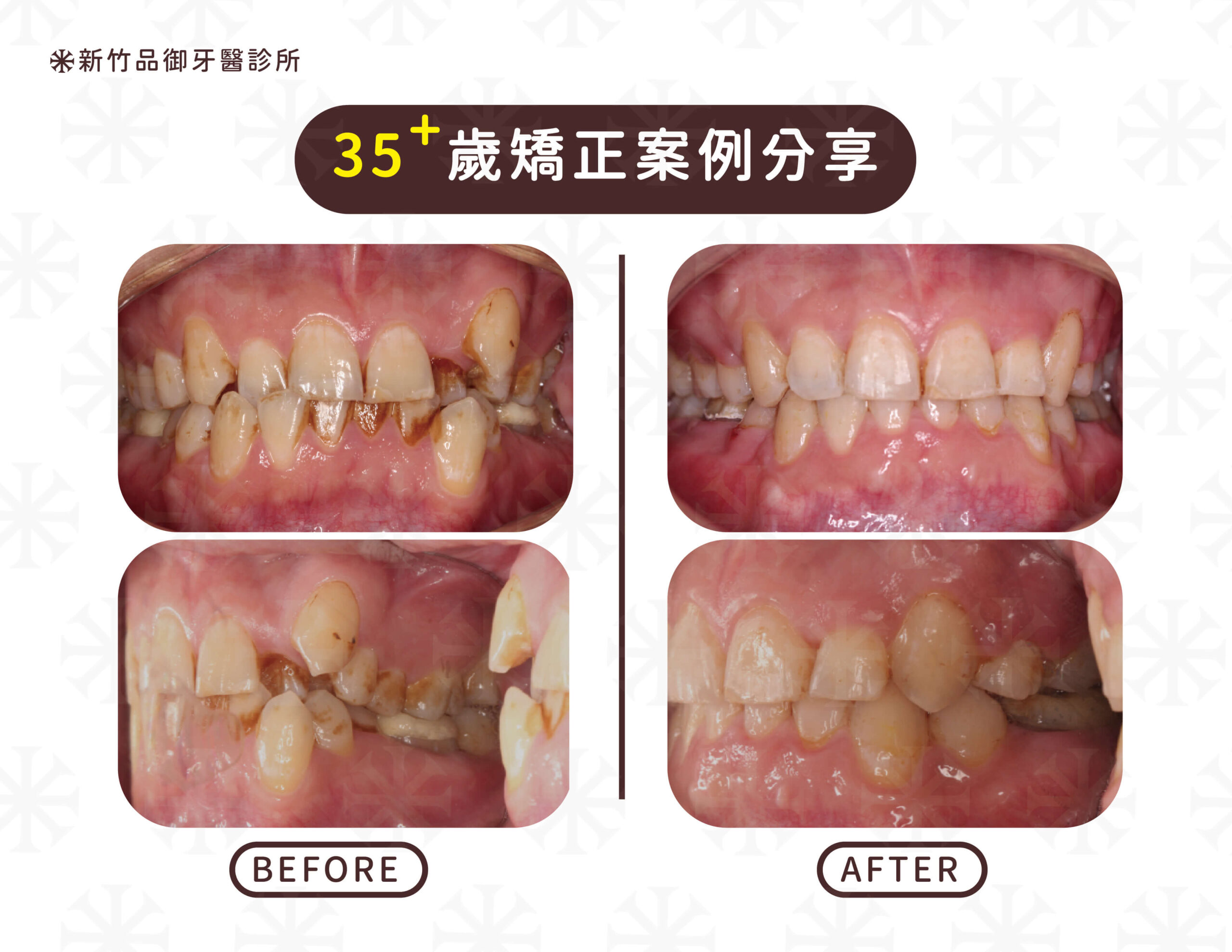 30 歲後的牙齒矯正，美觀就不再是最重要的考量因素，而是醫師會考慮恢復口腔功能為優先考量。