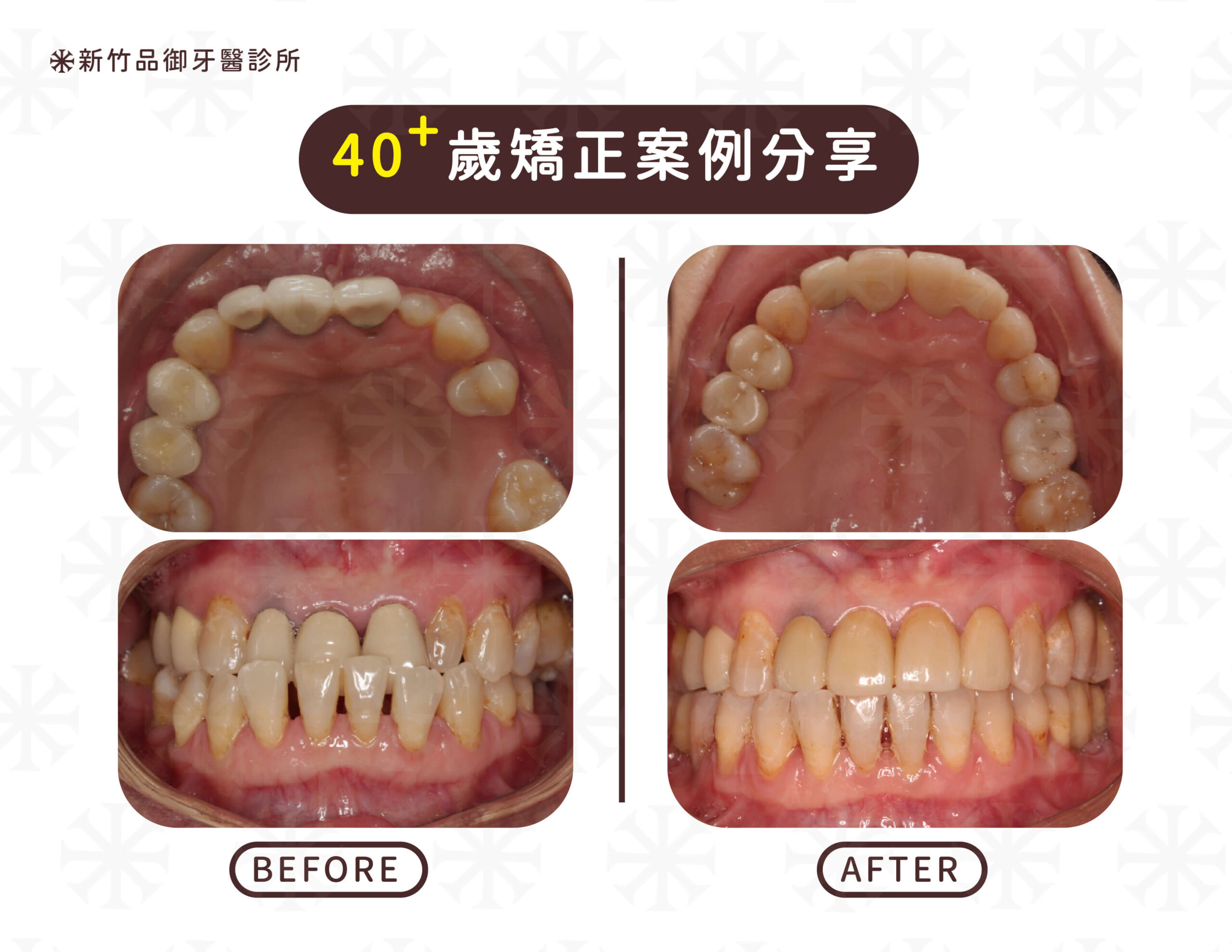 年紀越大矯正時，需要合併其他治療的機率也越大