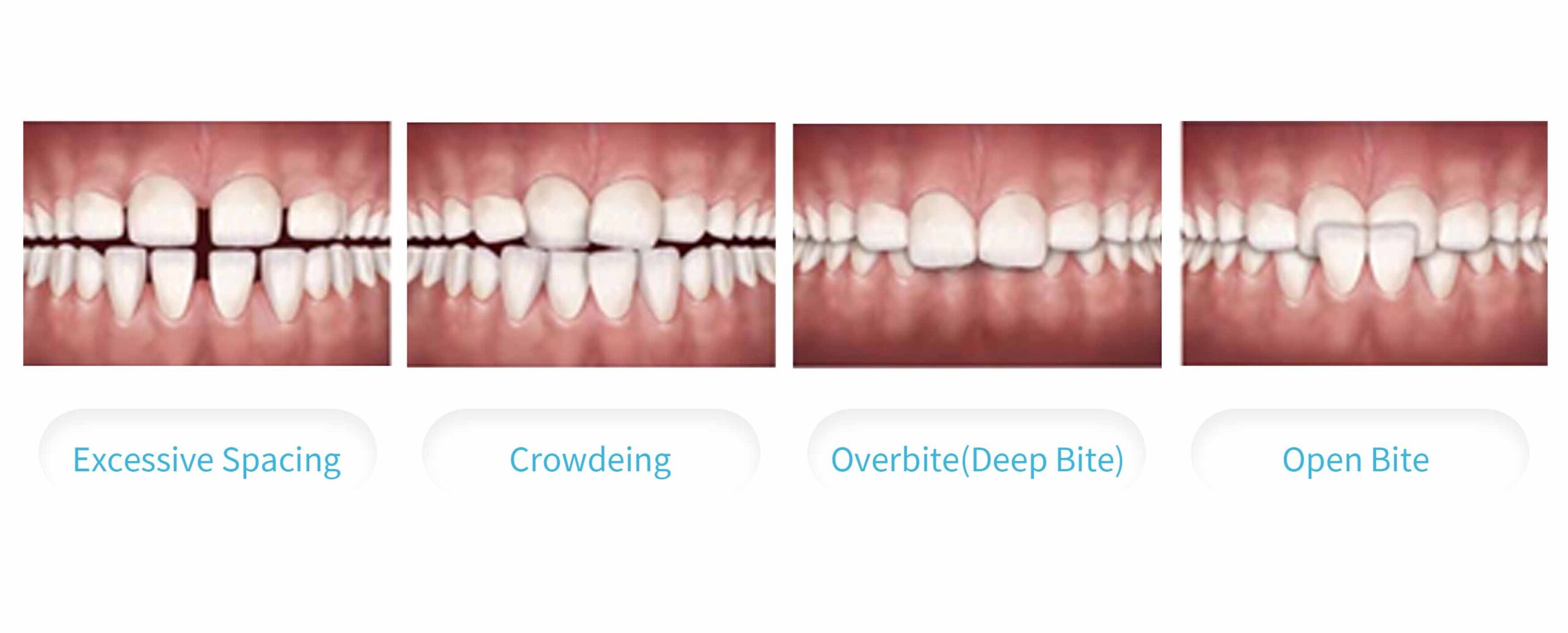 新竹牙齒矯正 什麼情況下需要矯正