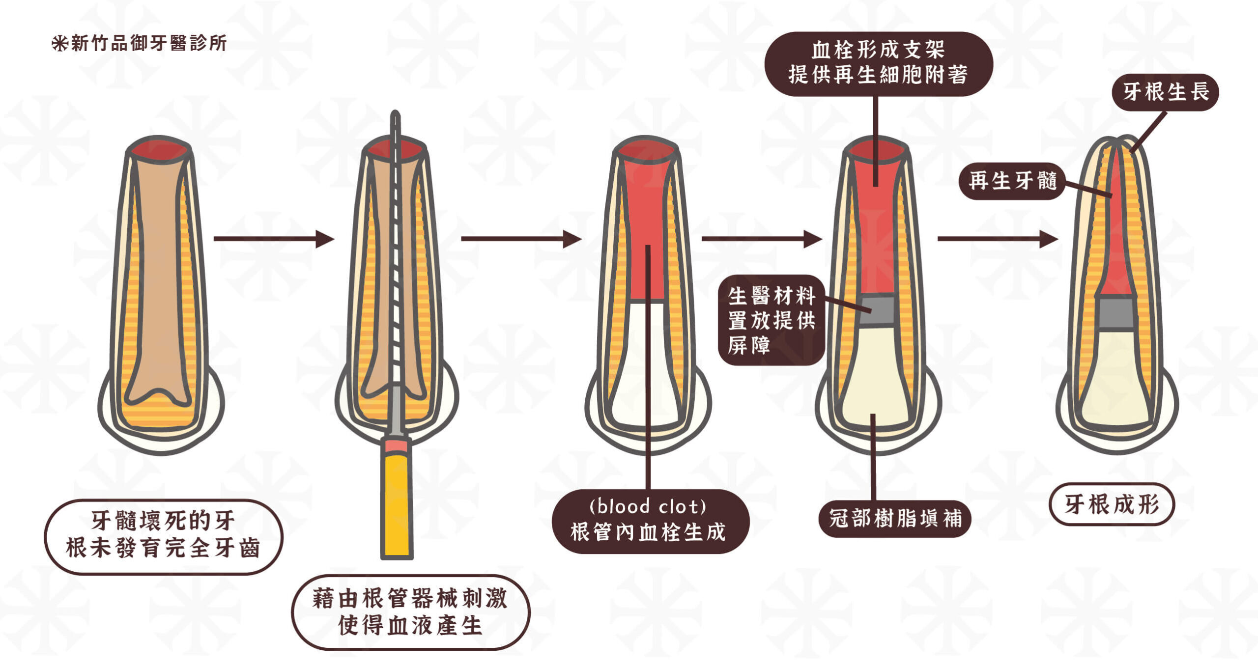 再生牙髓治療的過程