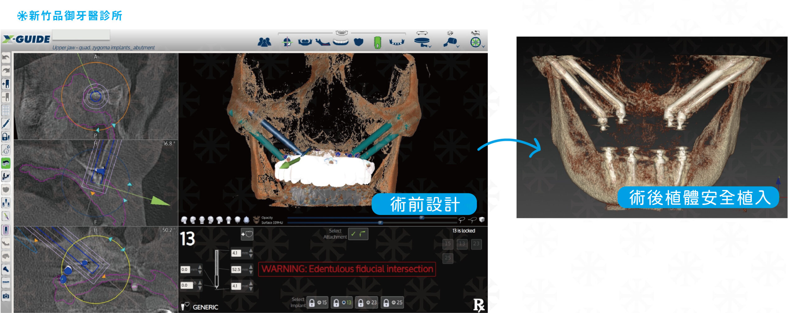 單側 All on 4顴骨植體