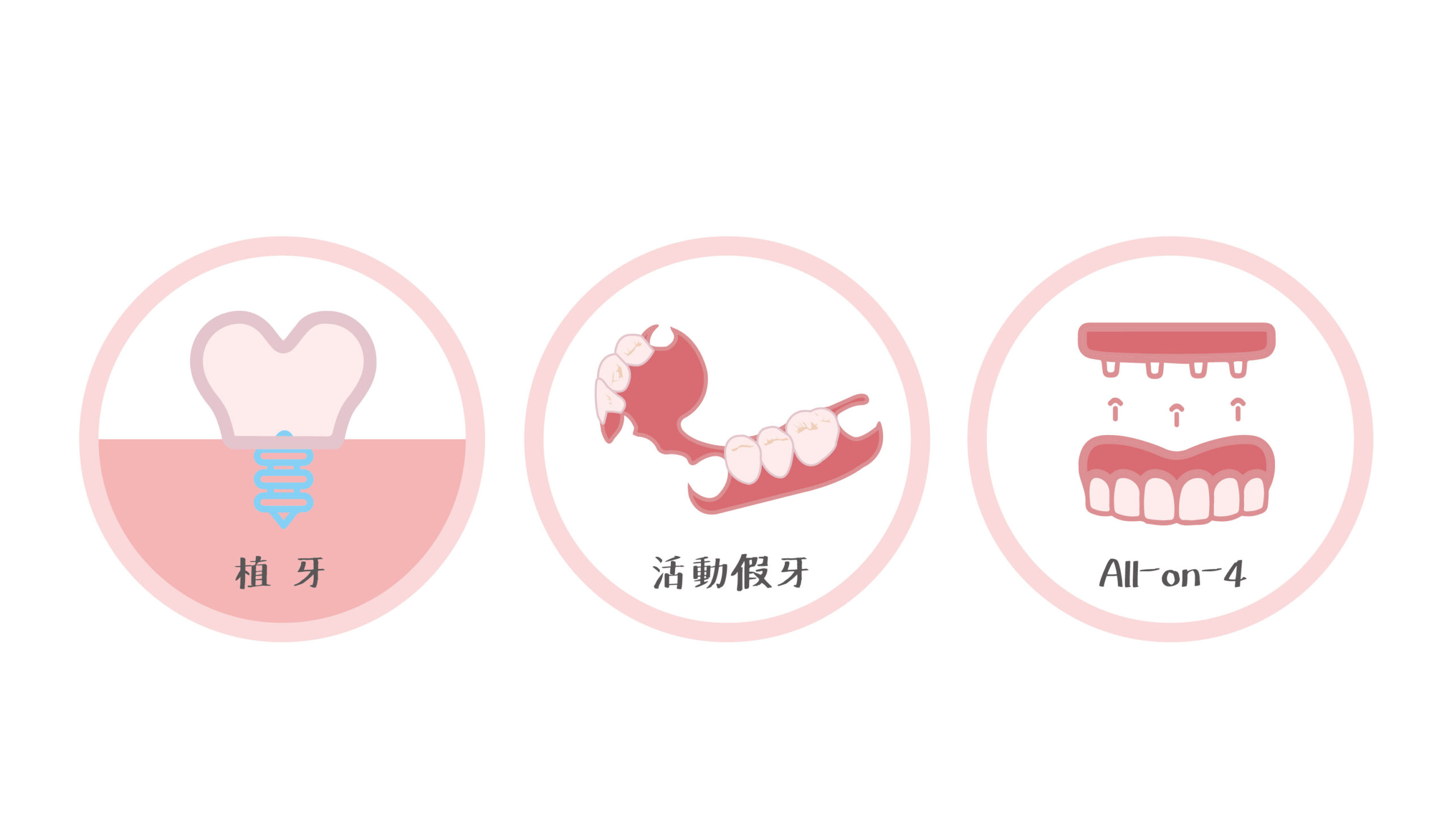 缺牙可能的解決方式