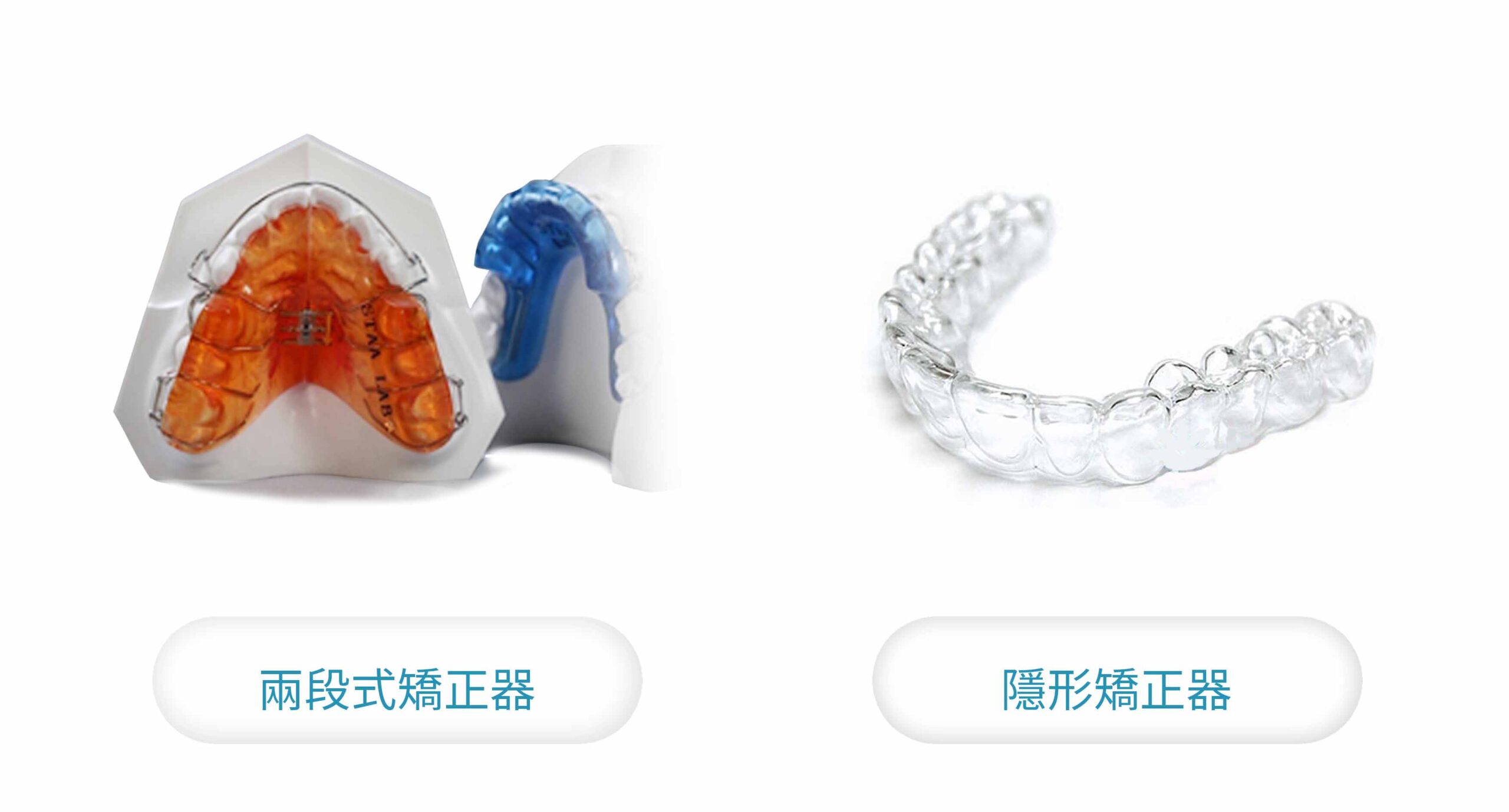 牙齒矯正 適合傳統矯正還是隱形矯正