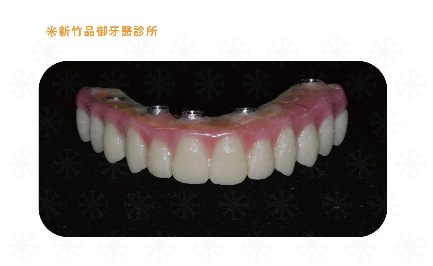 All on 4 塑鋼牙又稱為樹脂臨時假牙