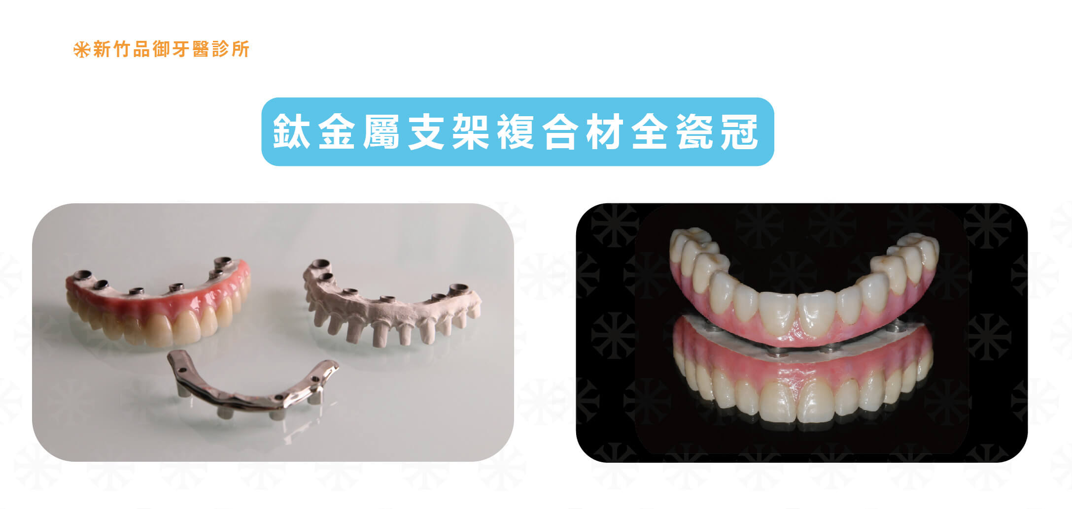 All on 4 鈦金屬支架複合材質全瓷冠