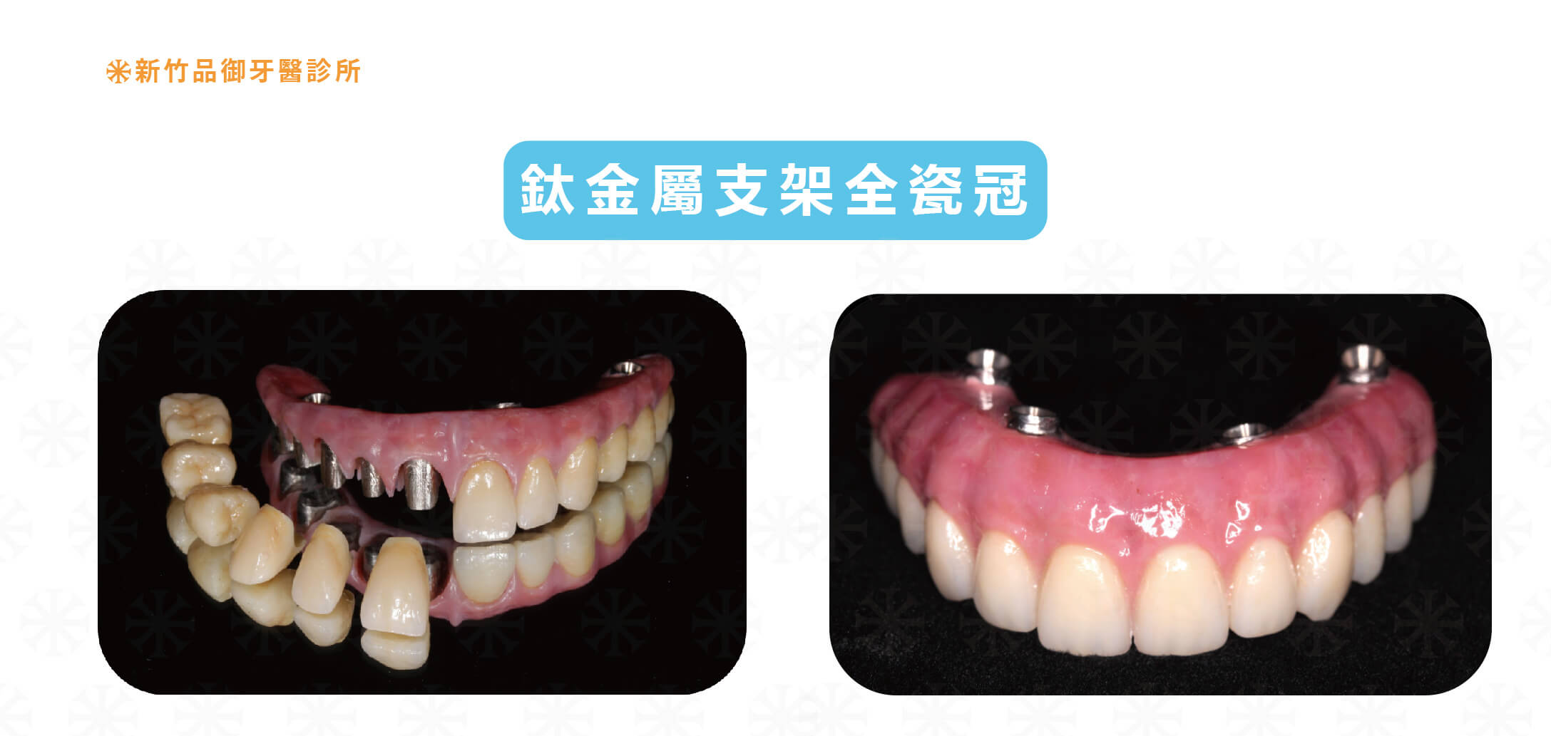 All on 4 鈦金屬支架全瓷冠