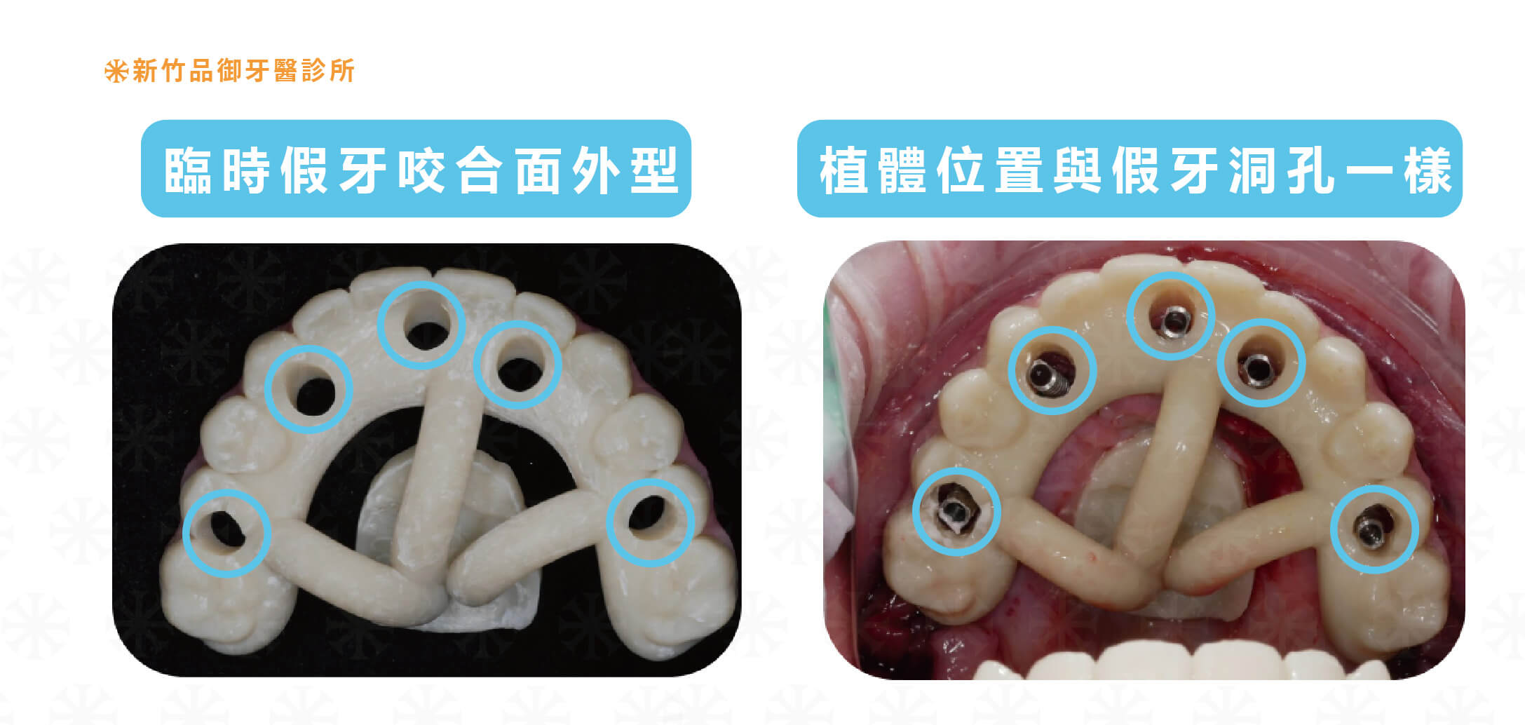3D 藍光導航假牙植體位置的洞