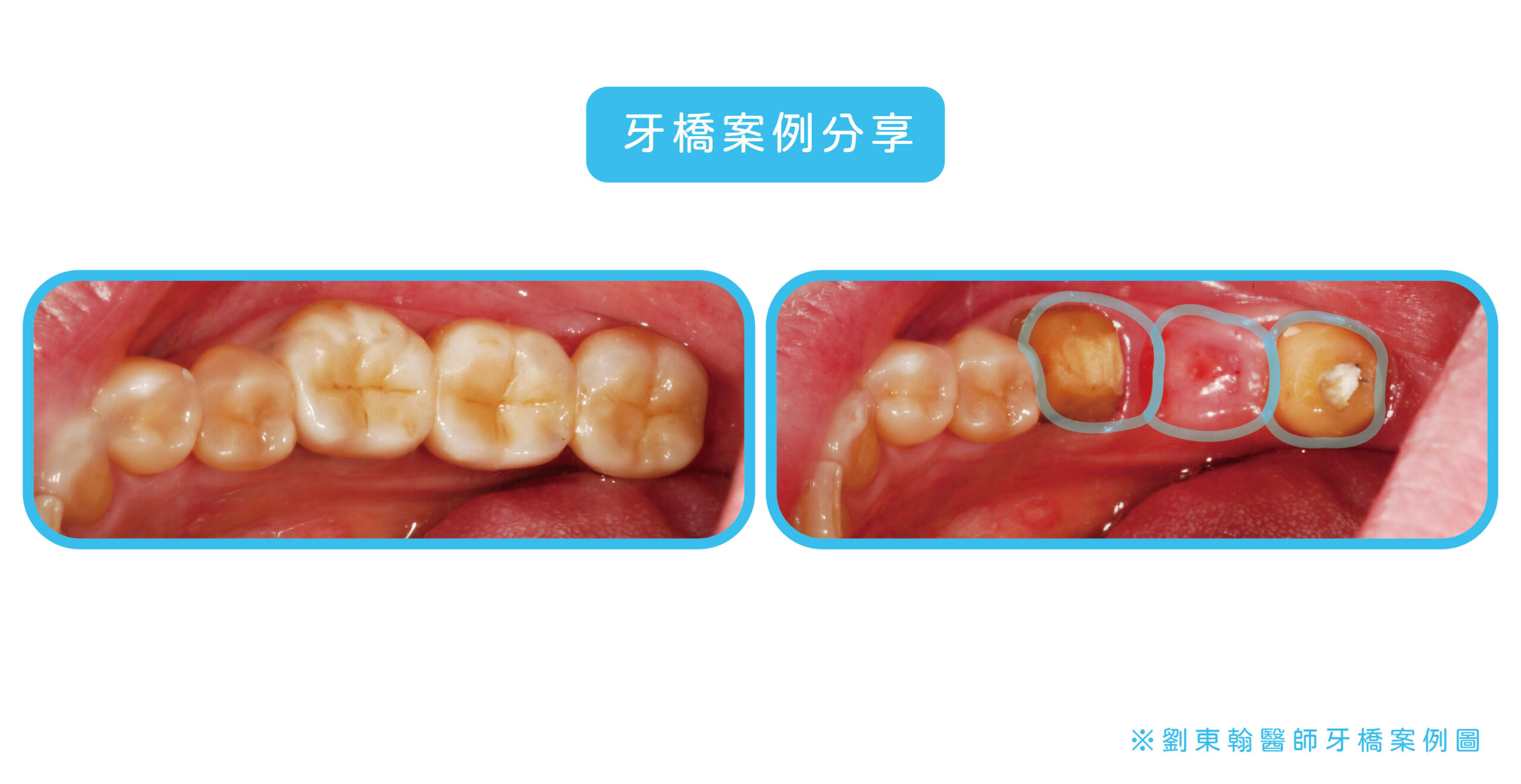 劉東翰醫師的牙橋案例