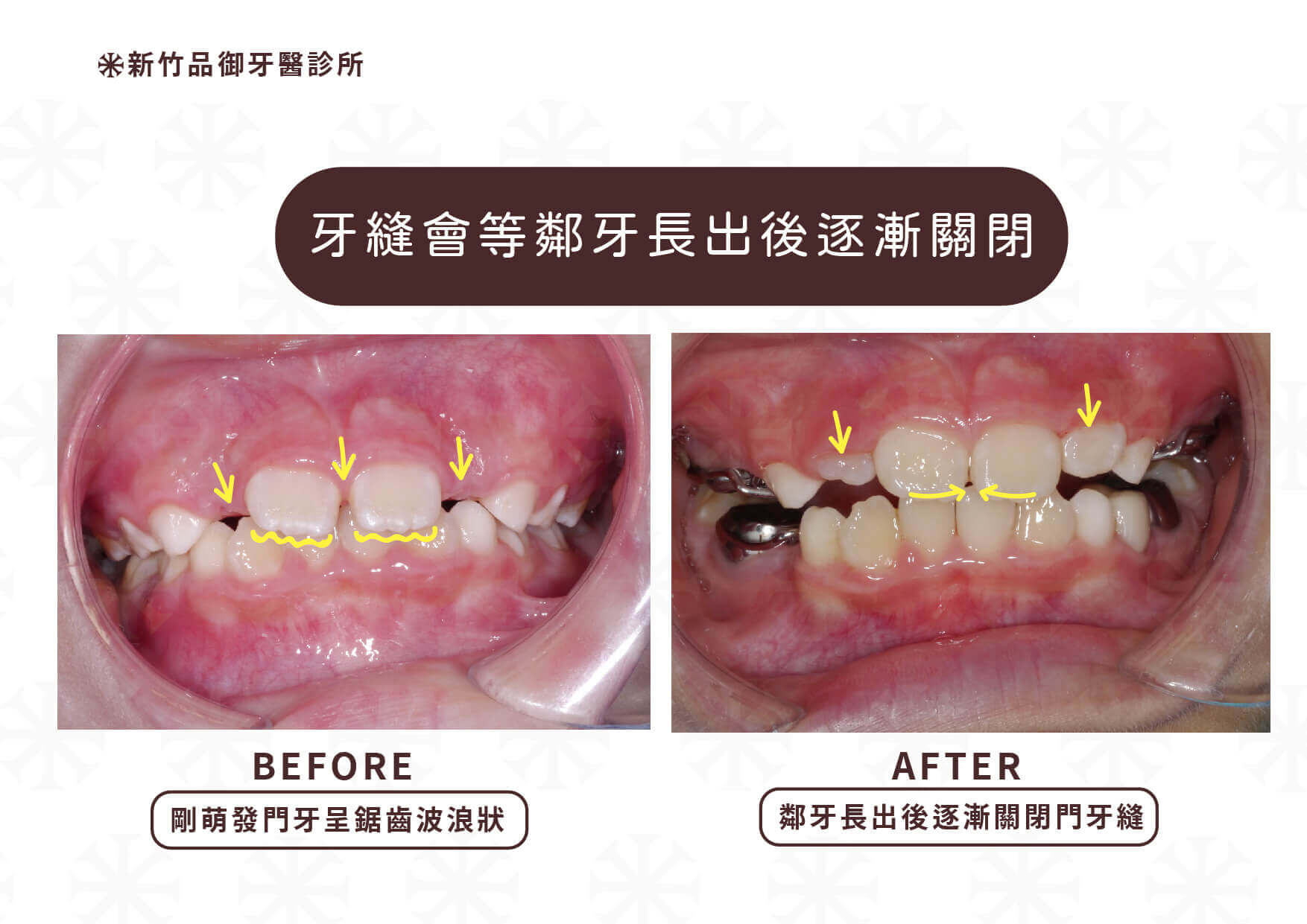 剛長出的恆牙顏色較黃、切緣為鋸齒狀，牙縫也會因為鄰牙長出而逐漸關閉
案例提供：品御牙醫  許雯婷醫師