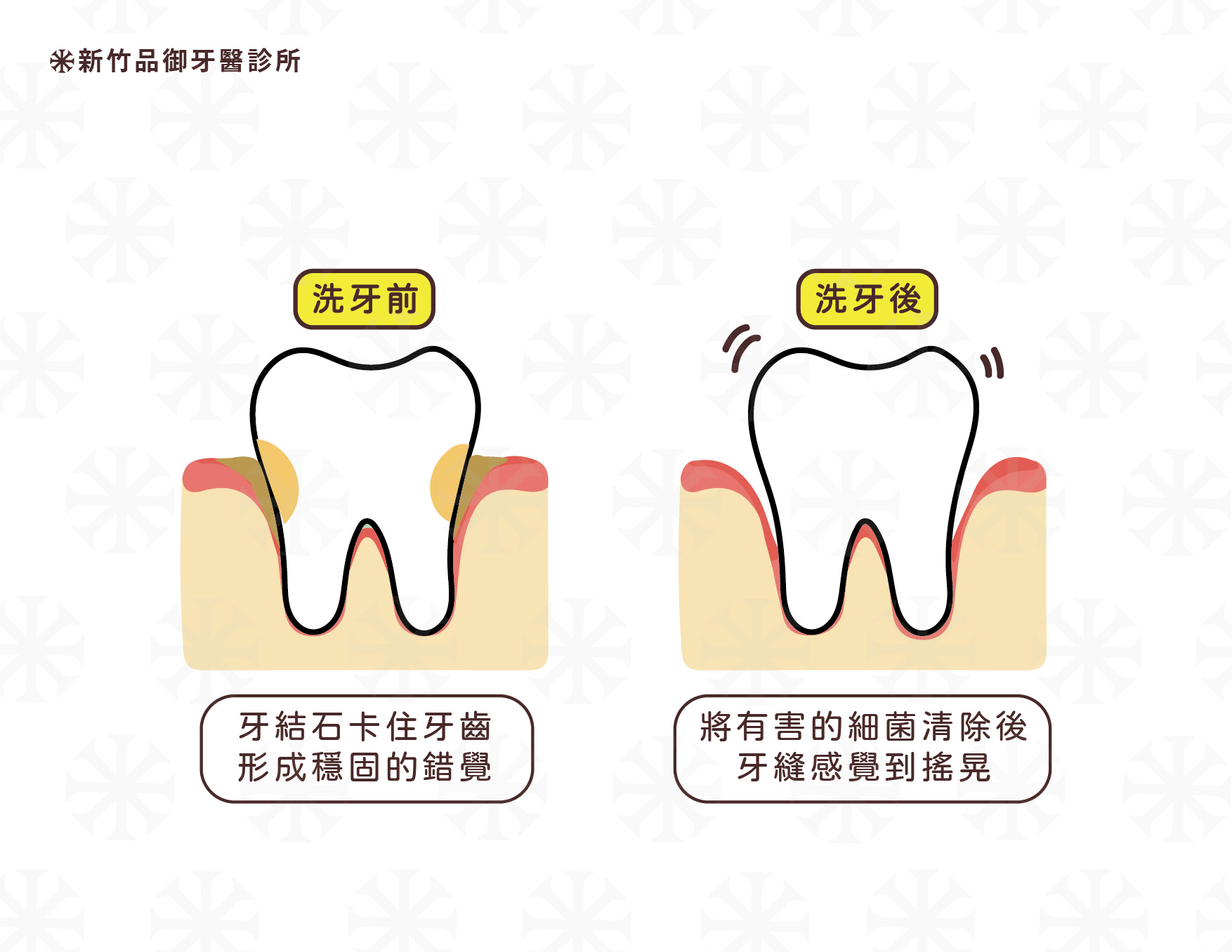 不同牙齒表面的牙結石慢慢的疊加在一起，而讓病患感覺牙齒很穩固，實際上很有可能牙齒周圍的骨頭已經破壞很嚴重了，以至於醫師將一整排牙結石清除後，讓病患有洗牙之後反而牙齒變搖晃的感覺，但實際上醫師是將有害身體健康的細菌清除，讓病患更容易維護牙齒清潔。