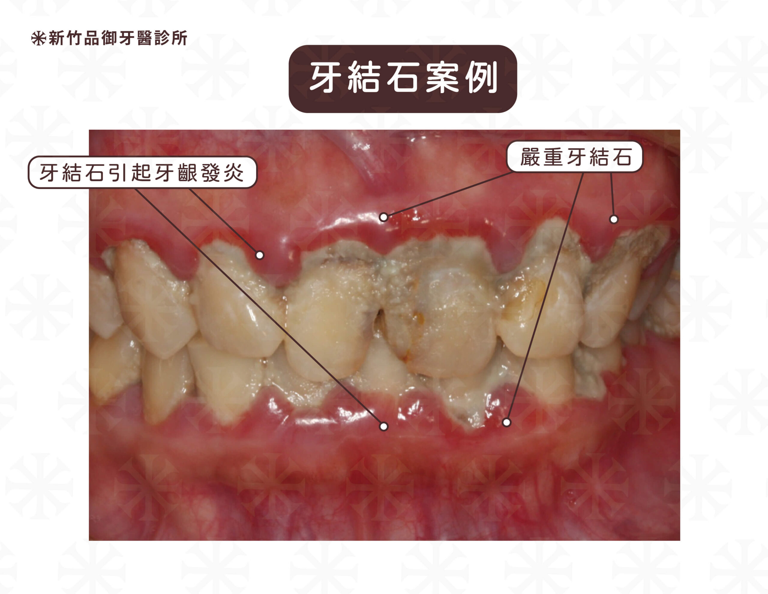 牙結石引起牙齦發炎，洗牙後原本的牙結石附著與牙齒周圍骨頭喪失，會導致感覺冷熱敏感甚至有牙齒搖晃的感覺。