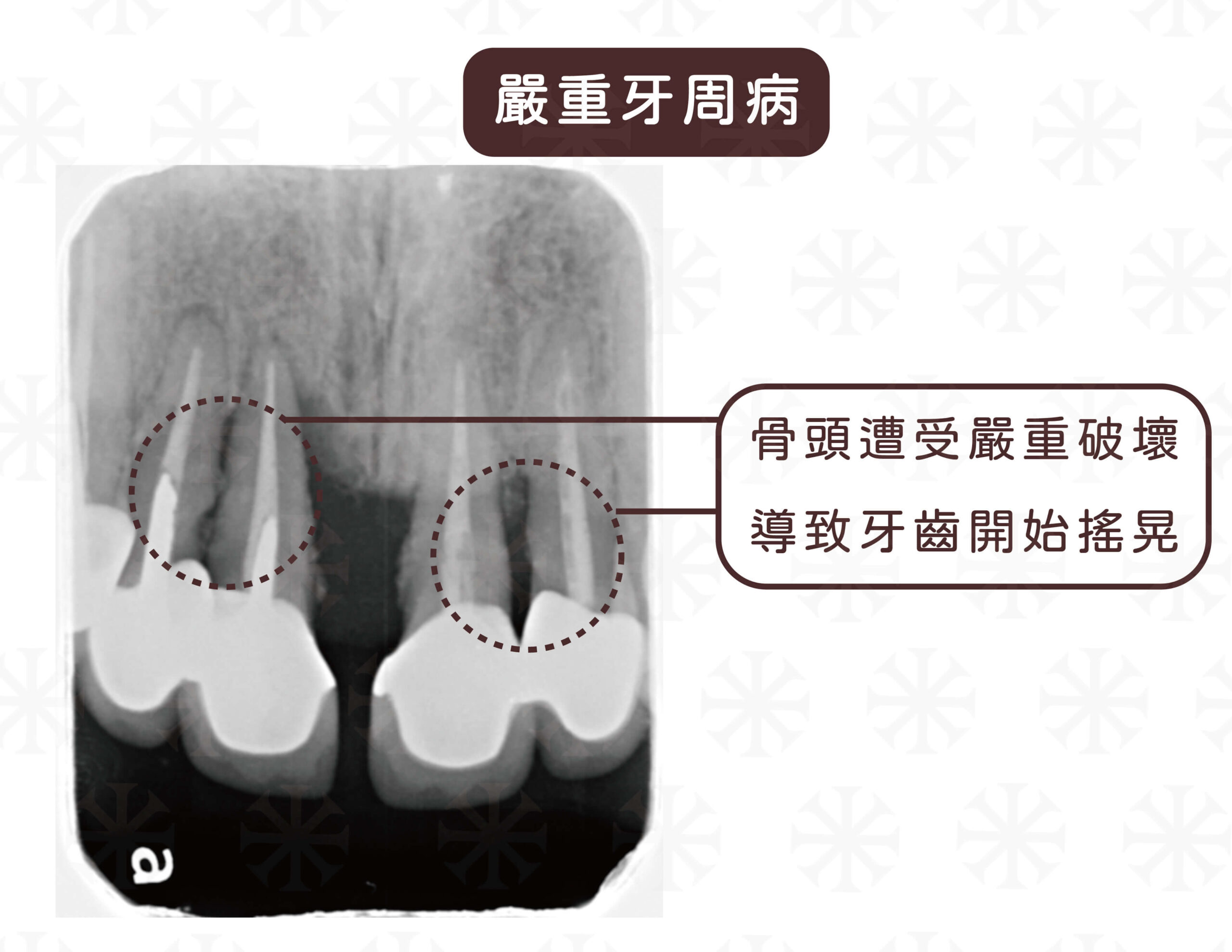 嚴重牙周病因為骨頭遭受嚴重破壞導致牙齒開始搖晃。