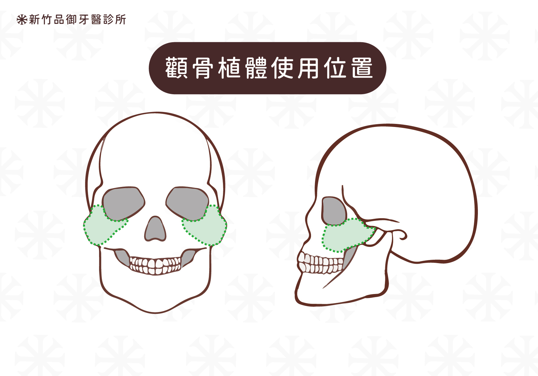顴骨植體使用位置