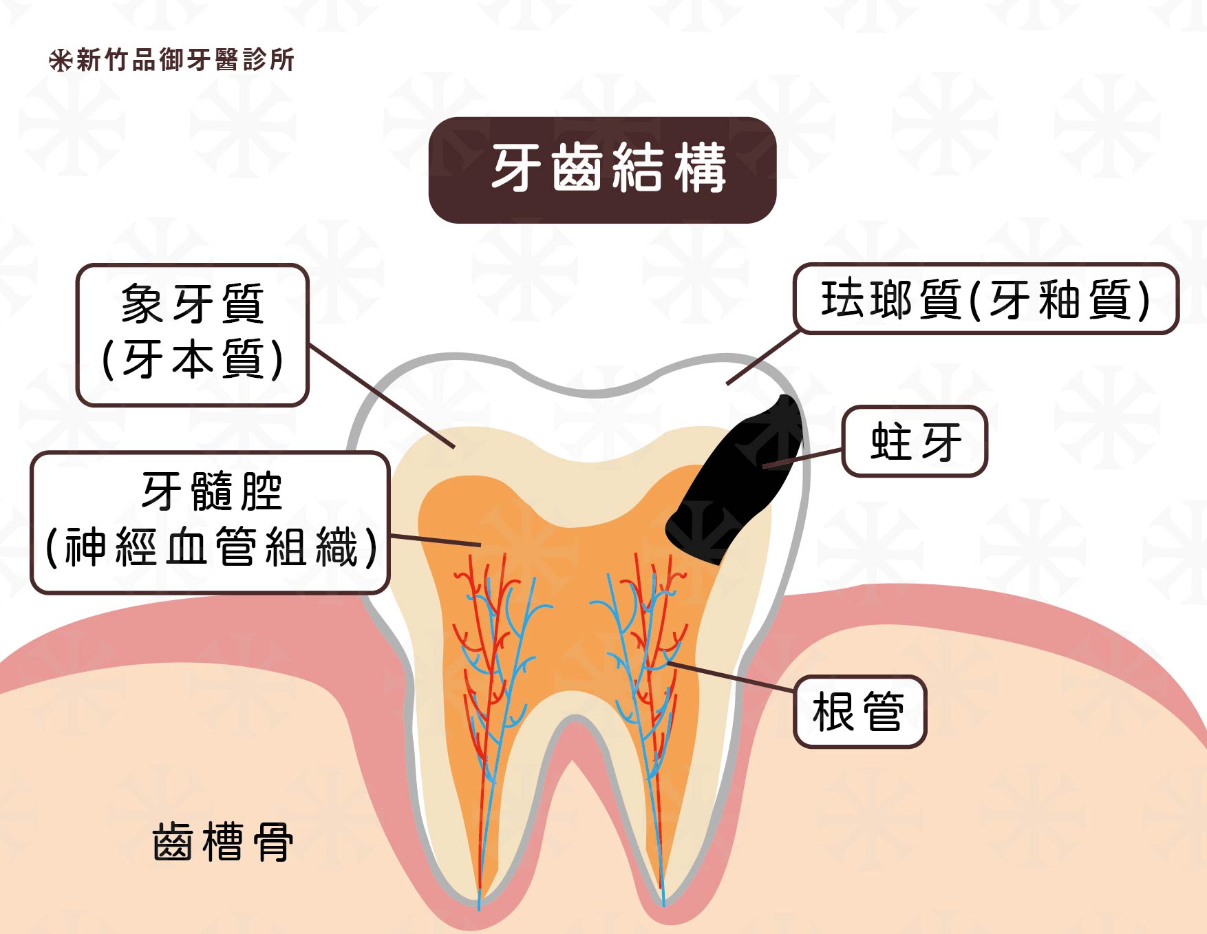 需要根管治療的主因：蛀牙範圍已經侵犯到牙髓腔
