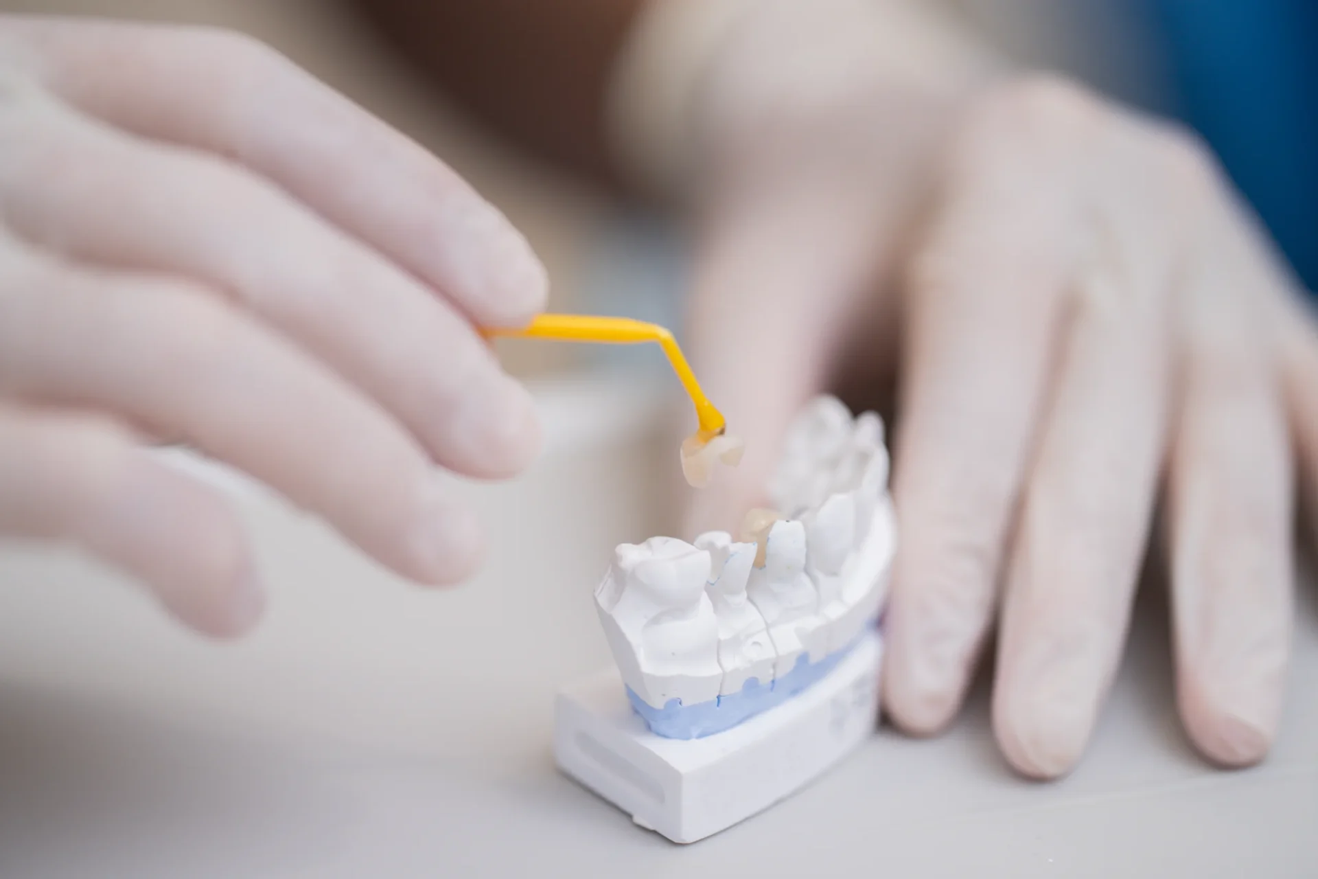 Prosthetic restoration