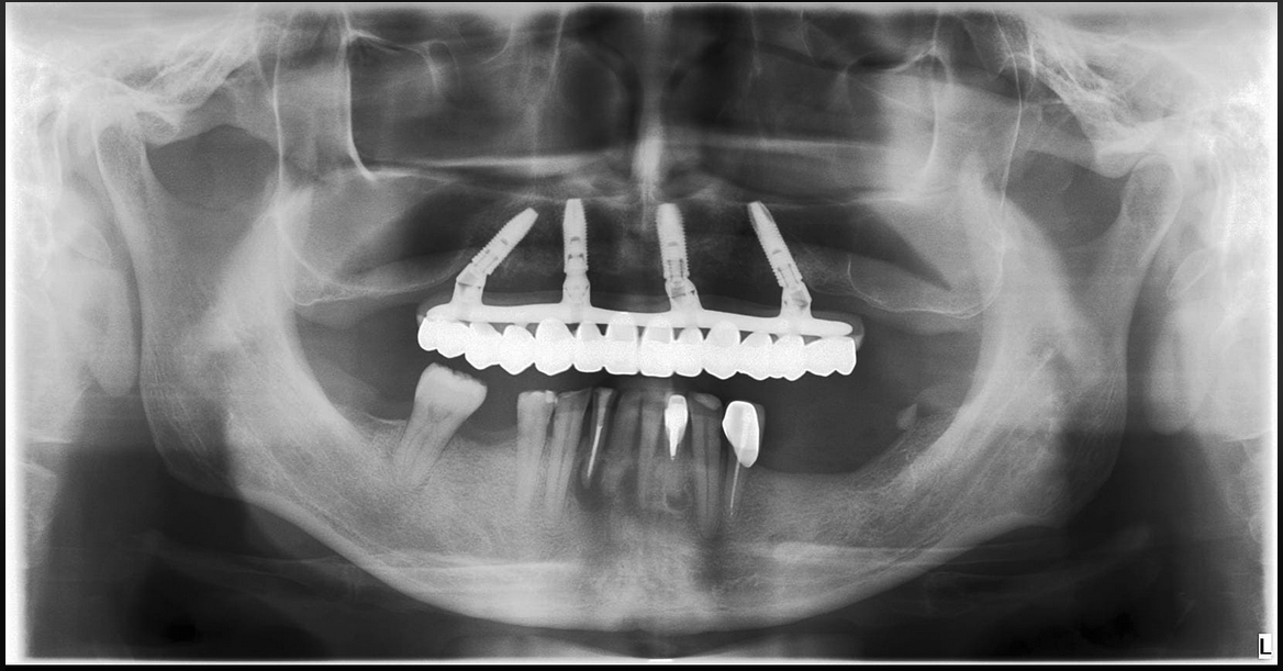 all-on-4全口植牙術後Ｘ光