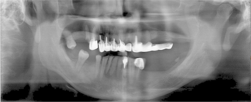 all-on-4全口植牙術前X光
