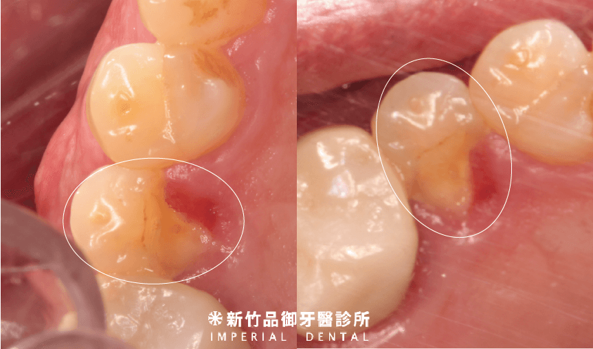 裂齒缺了一角的兩個不同角度圖片