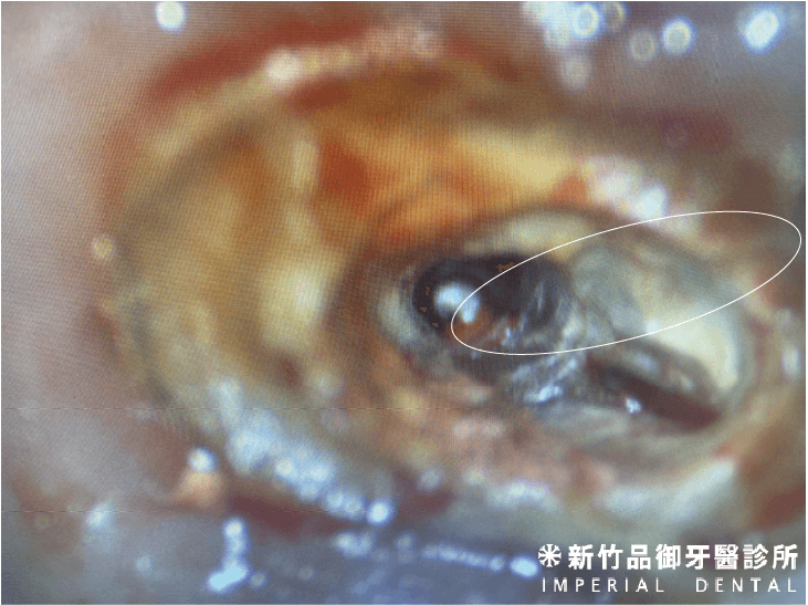 牙裂延伸至牙齒根管內