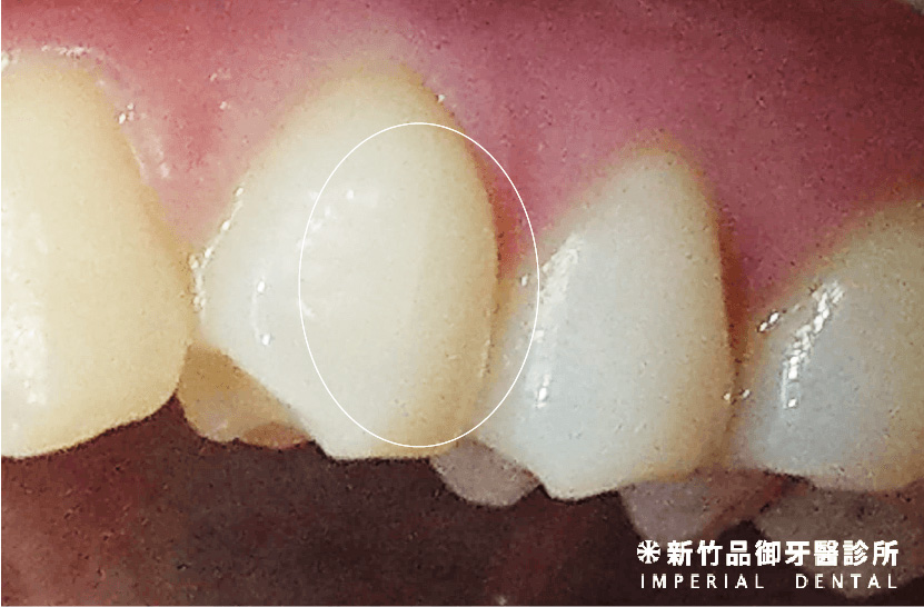 牙齒上有小裂紋
