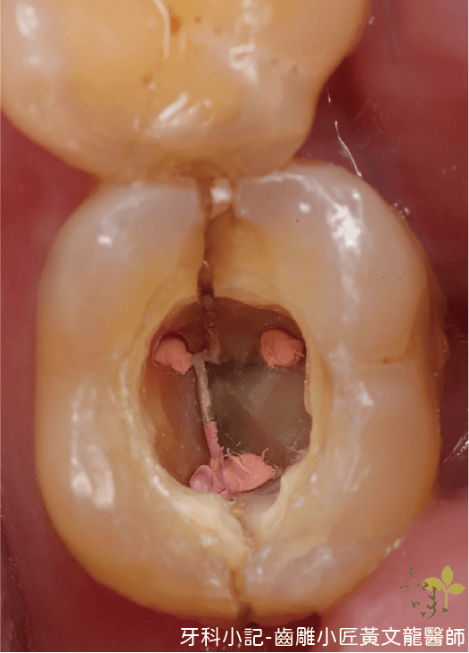 咬頭斷裂的俯視照