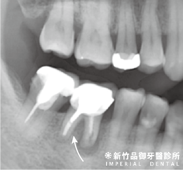 根尖切除術X光