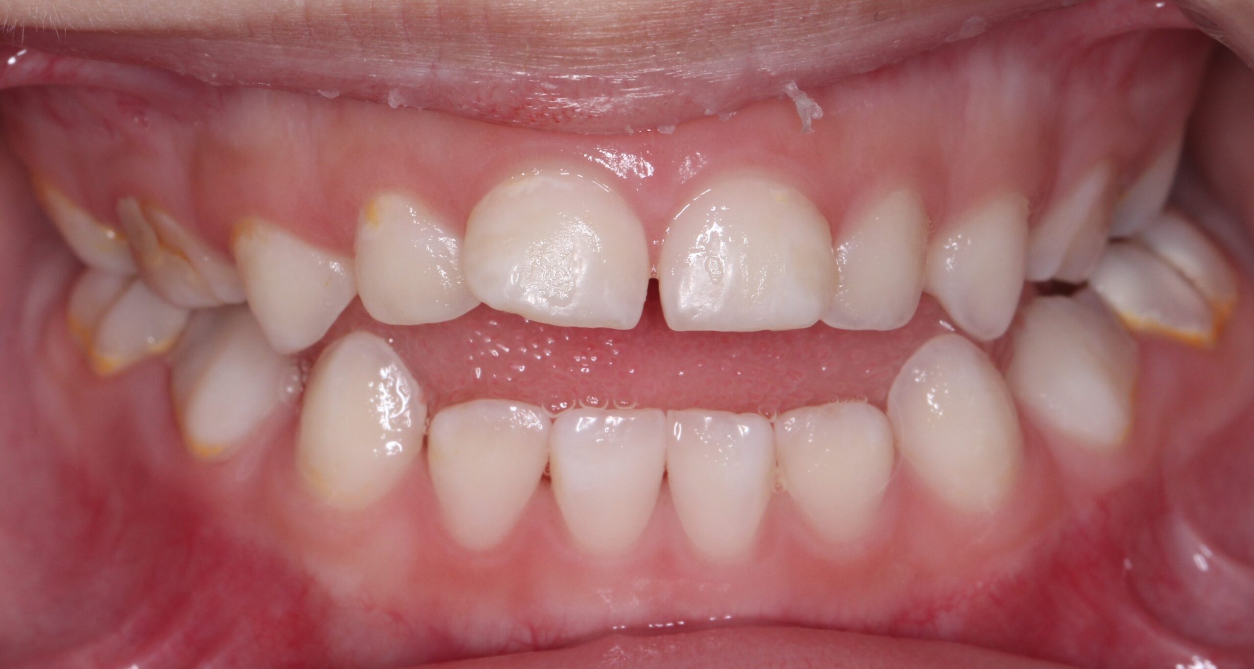 新竹兒童矯正，吐舌造成前牙開咬