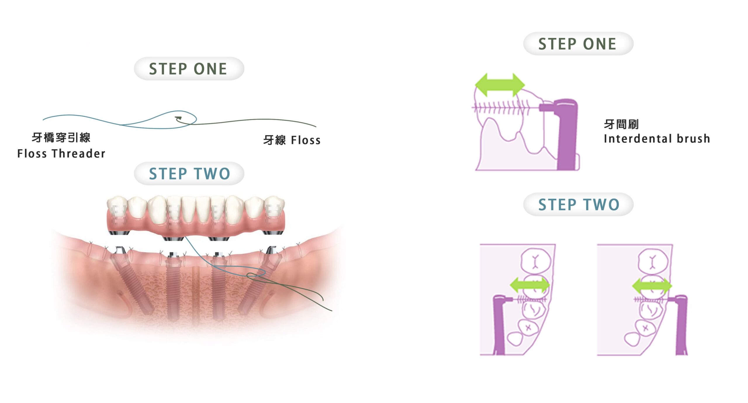 牙橋穿引線及牙間刷的正確使用方式