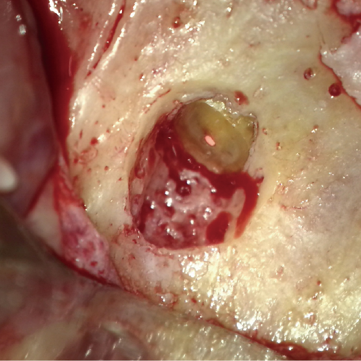 透過牙科顯微鏡可以清楚定位發炎位置