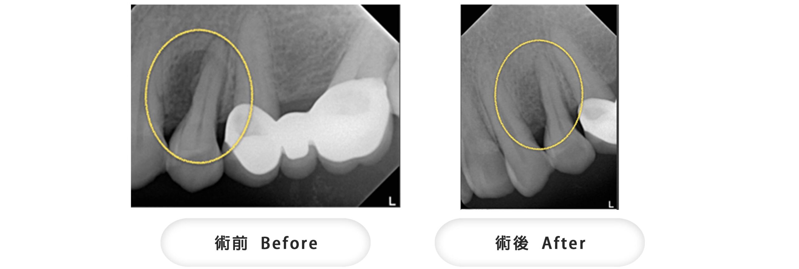 牙周再生手術，經過翻瓣清創後，填補骨粉及再生膜，可見到骨頭長回來。