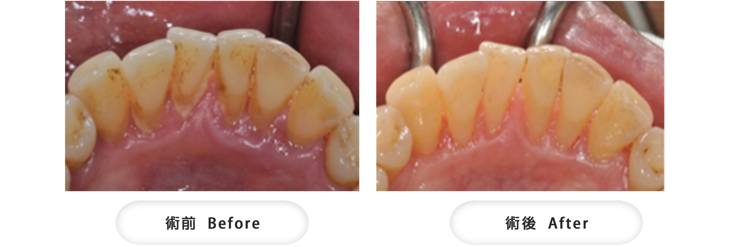牙周治療前，可見下顎牙齦浮腫暗紅、膿液；治療後牙齦膿液消失並恢復健康的粉紅色