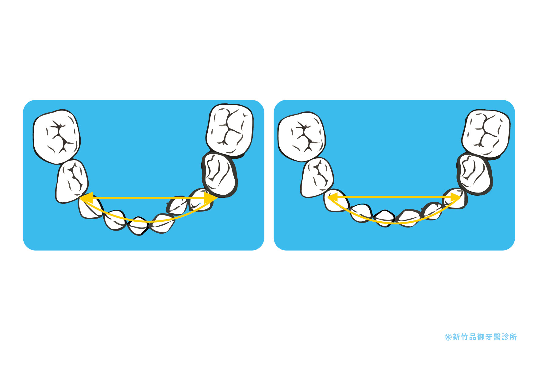長四顆恆門齒後，牙弓寬度及彎曲度增大。