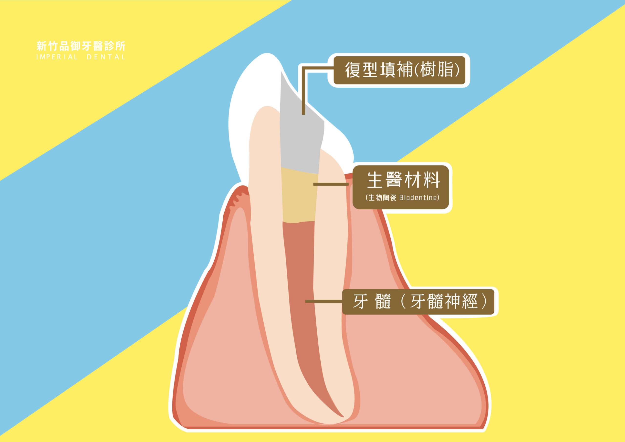 活髓治療側面牙齒填補圖