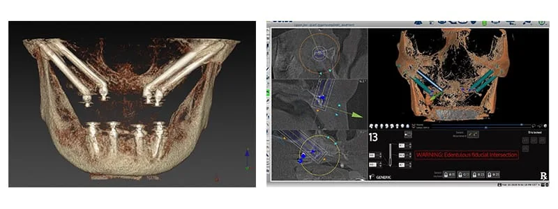 精準數位藍光導航 X-Guide 進行四支顴骨植體技術