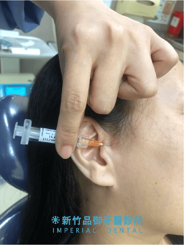 顳顎關節症候群玻尿酸治療