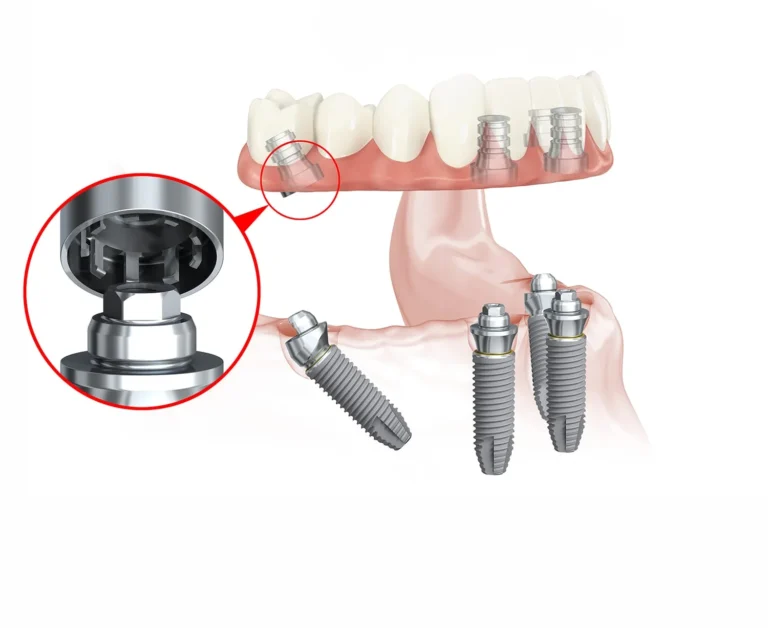 ▲ 假牙醫師裝上臨時假牙。