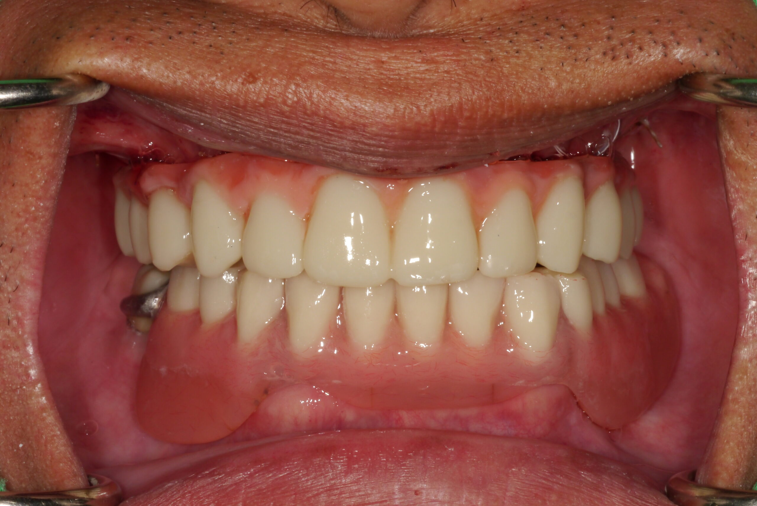 手術當日裝戴上臨時假牙