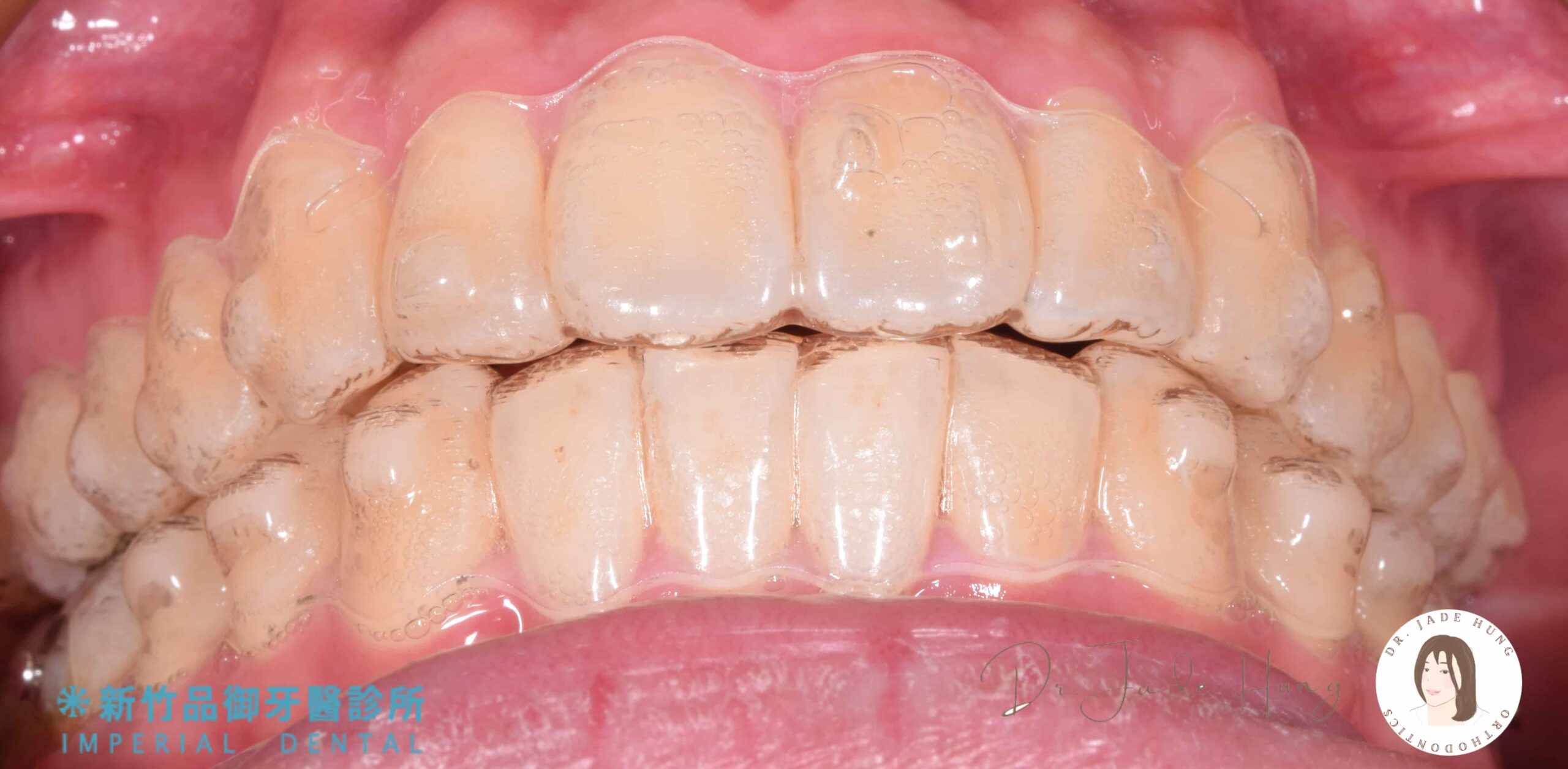 隱士美透明牙套實戴