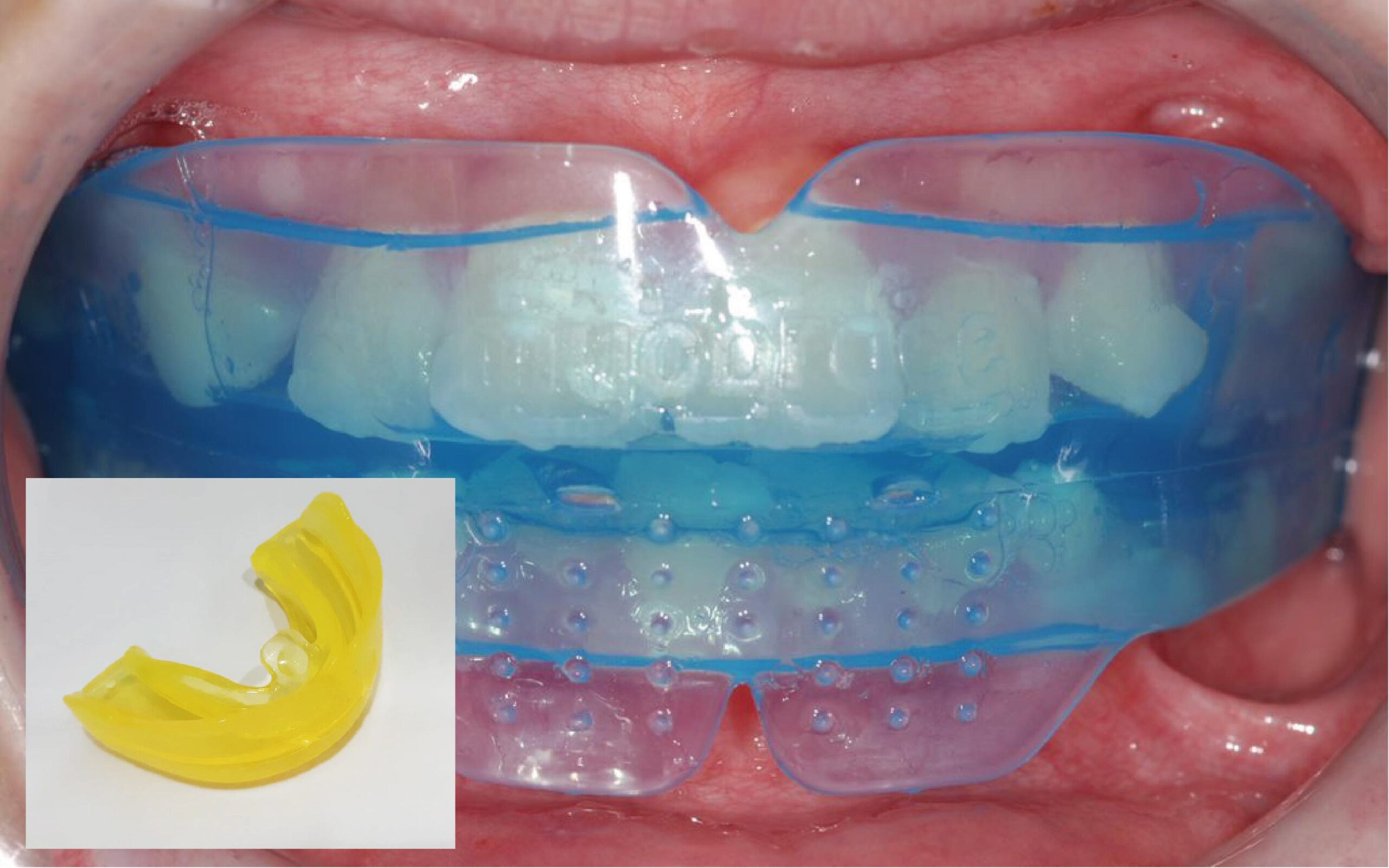 MRC／EF line ／Preortho肌功能矯正牙套