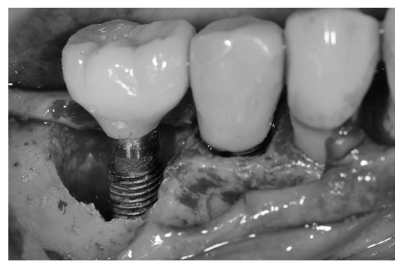 植體周圍炎 讓植牙周圍的齒槽骨遭到嚴重破壞