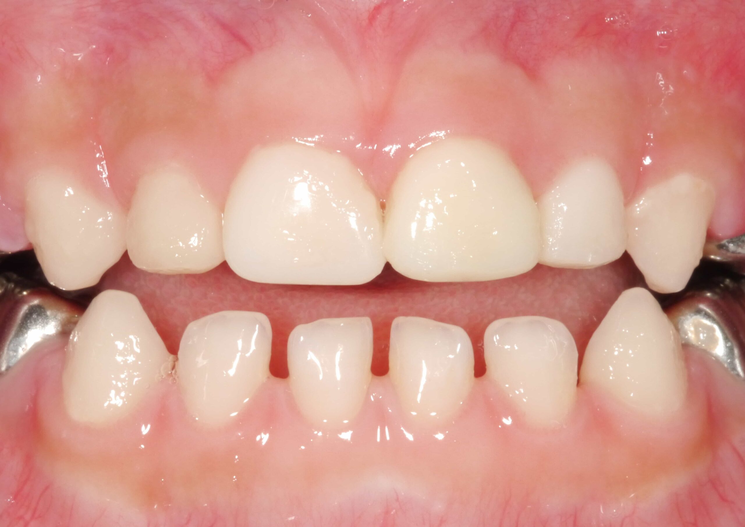 舒眠治療後恢復笑容