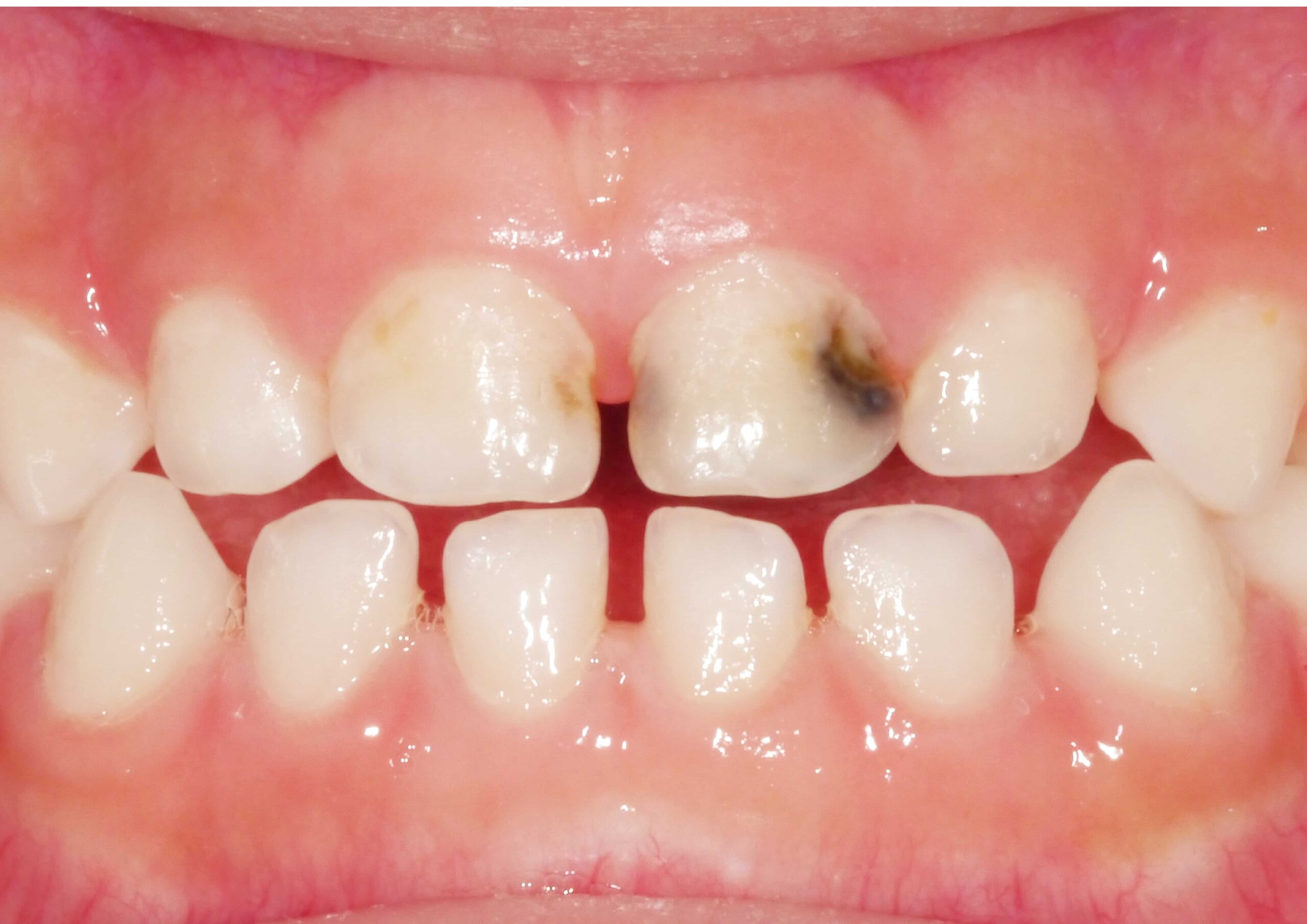 舒眠治療前有多顆蛀牙