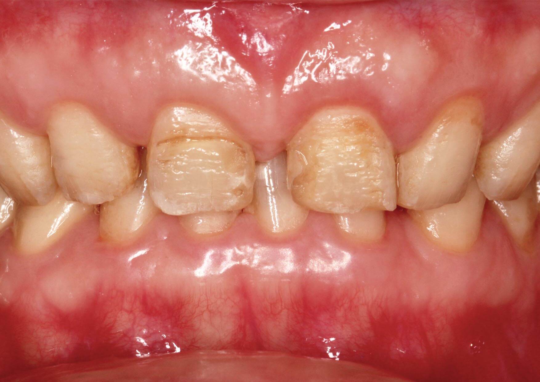 門牙缺損、牙縫過大等牙齒問題