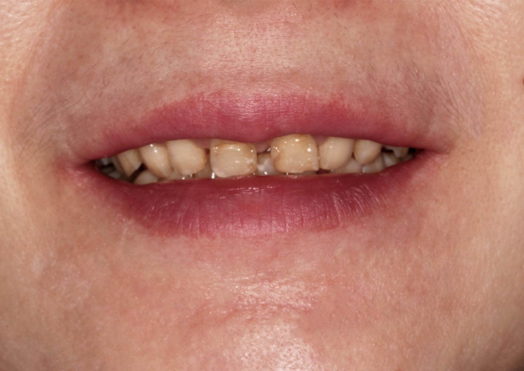 門牙缺損、牙縫過大等牙齒問題