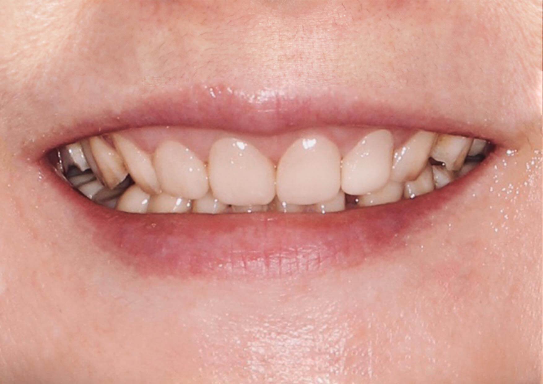 裝戴上正式假牙的案例照