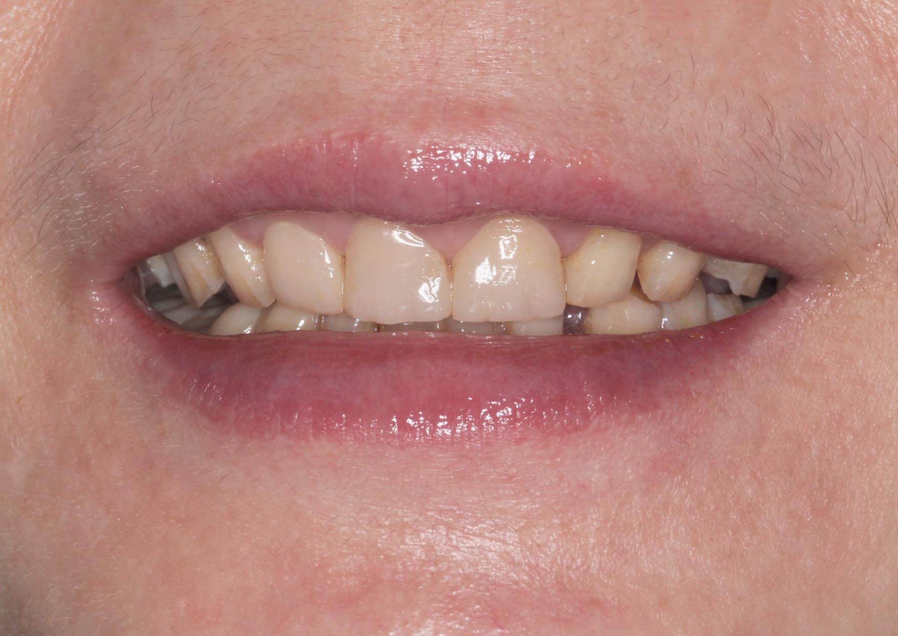 裝戴上臨時假牙的案例照